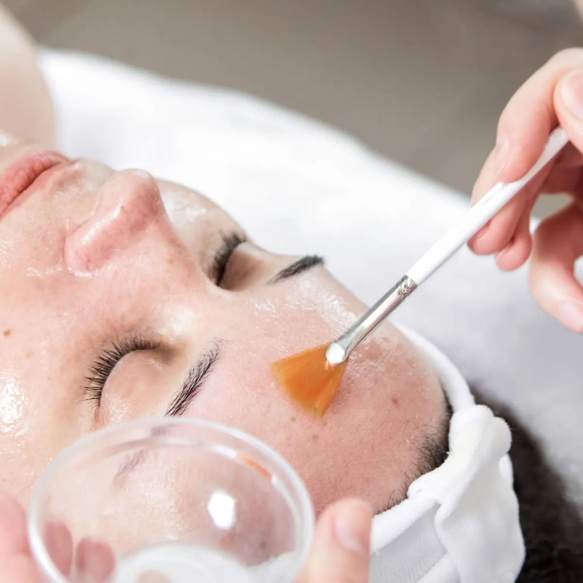 PEEL AND MELASMA TREATMENT